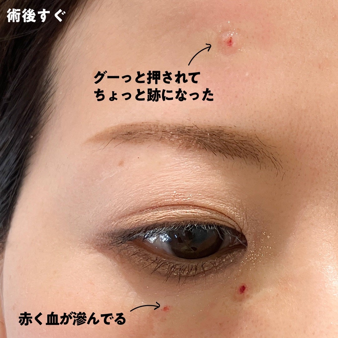 ピュアベール(医薬品)/プロペト/その他を使ったクチコミ(4枚目)