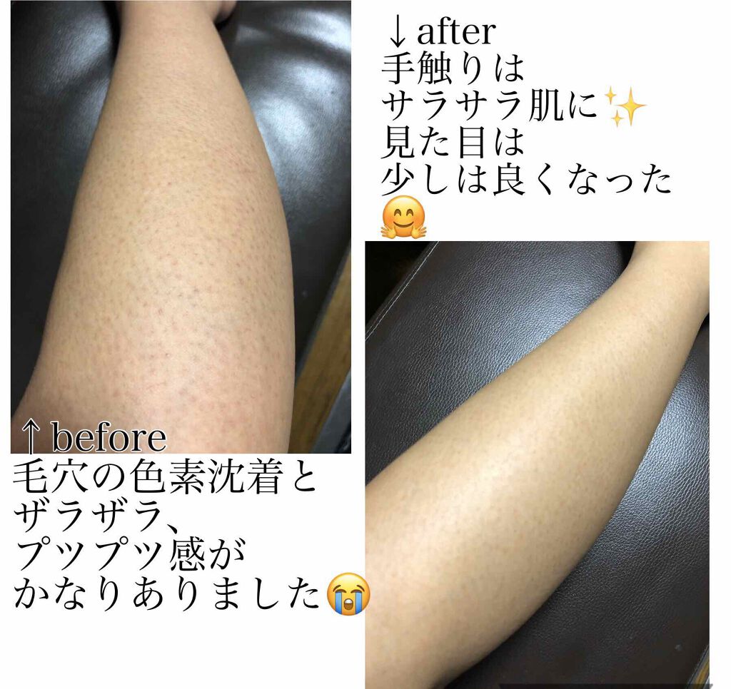 ケアノキュア 医薬品 小林製薬の口コミ 2枚目に汚い足の画像があります おそら By Lily 脂性肌 30代後半 Lips