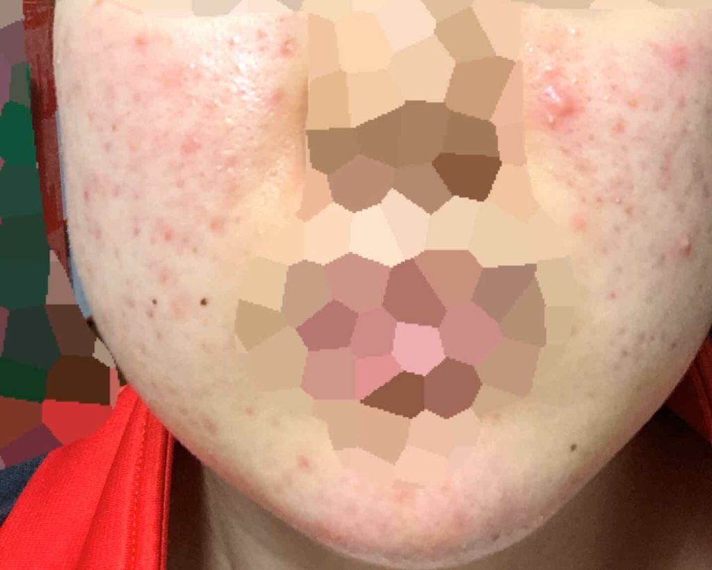 薬用3ステップセット30日サイズ/プロアクティブ/トライアルキットを使ったクチコミ（3枚目）