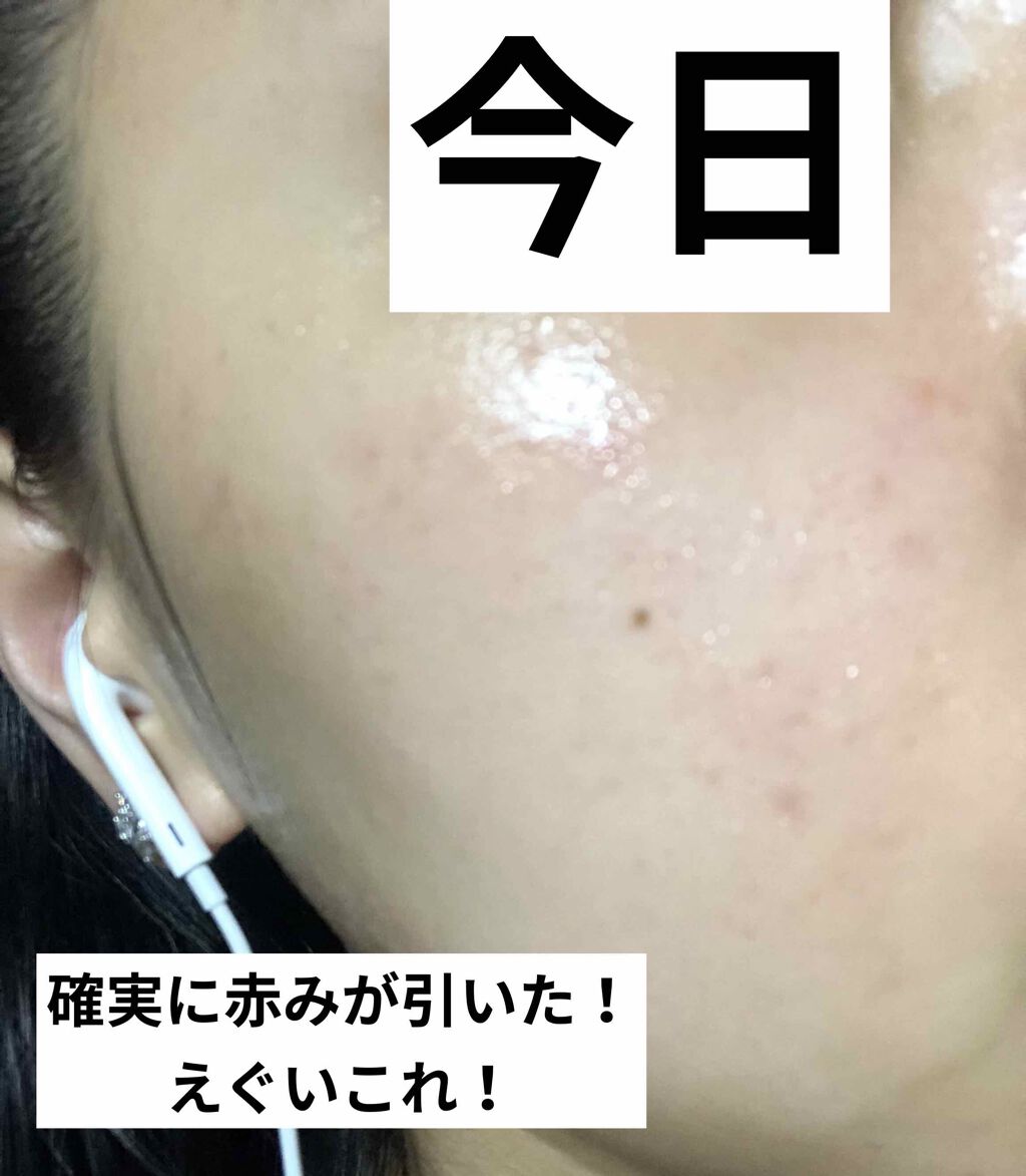 ペアアクネクリームW(医薬品)/ペア/その他を使ったクチコミ（3枚目）