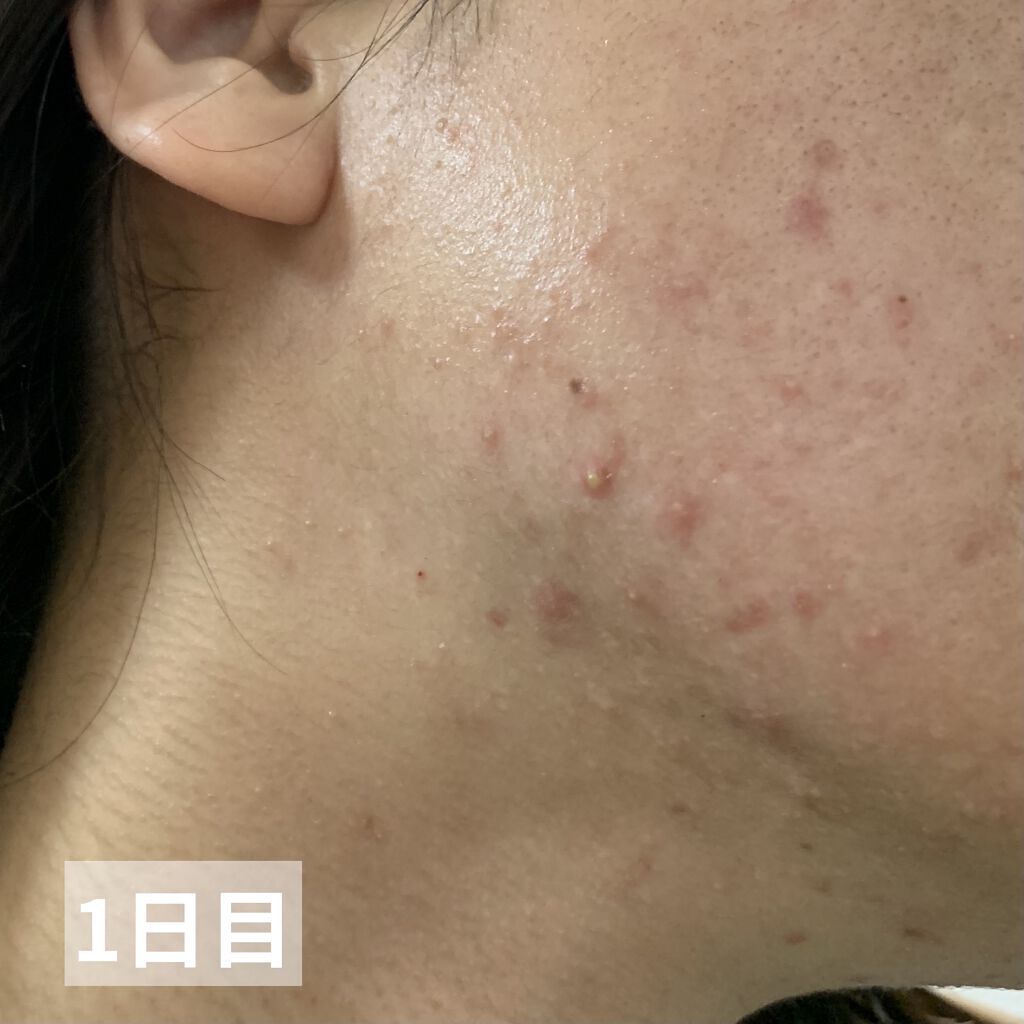 ペアアクネクリームW(医薬品)/ペア/その他を使ったクチコミ（3枚目）