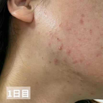 ペアアクネクリームW(医薬品)/ペア/その他を使ったクチコミ(3枚目)