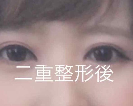 ブリッジファイバー 1.8mm/FD(エフディ)/二重まぶた用アイテムを使ったクチコミ(2枚目)