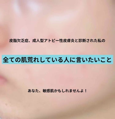 肌荒れしてる人ぜひ見て⚠️💦
あなたの時間を5分ください！

何使っても治らないあなたの肌荒れ、もしかして私みたいに敏感肌からくる肌荒れじゃありませんか？💦

「私は敏感肌じゃないわ！」って思った人、考