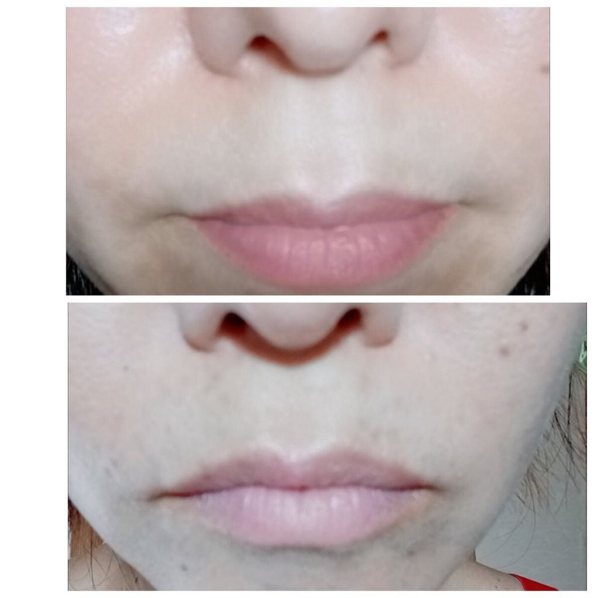 MJえむじぇー() on LIPS 「品川美容外科では渋谷院限定メニューだそうです。普段いつも上野院..」(4枚目)