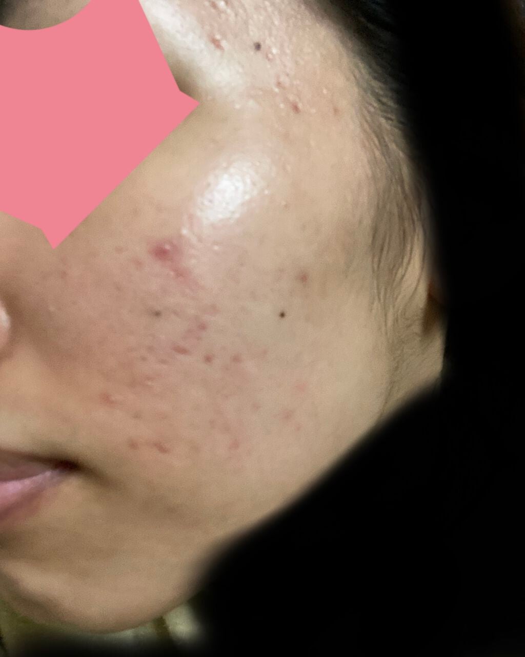 pink_sounds_rrza on LIPS 「べピオゲル1ヶ月経過ニキビはまじでできなくなった、ニキビ跡は前..」(2枚目)