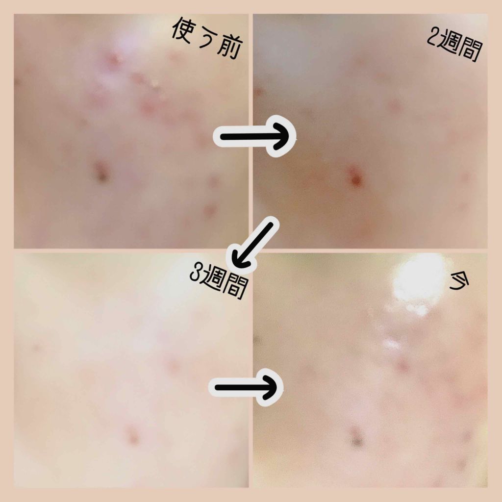 ペアアクネクリームW(医薬品)/ペア/その他を使ったクチコミ（2枚目）