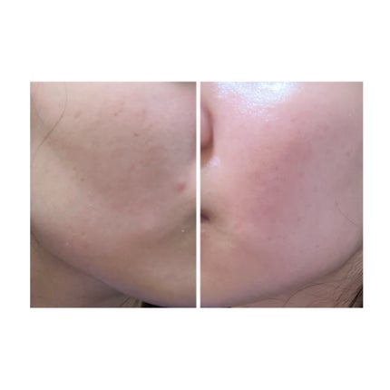 ぽむ on LIPS 「2023.9.13皮膚科に受診 エピデュオとヘパリン処方1枚目..」(5枚目)