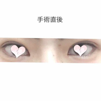 二重整形/その他を使ったクチコミ(3枚目)