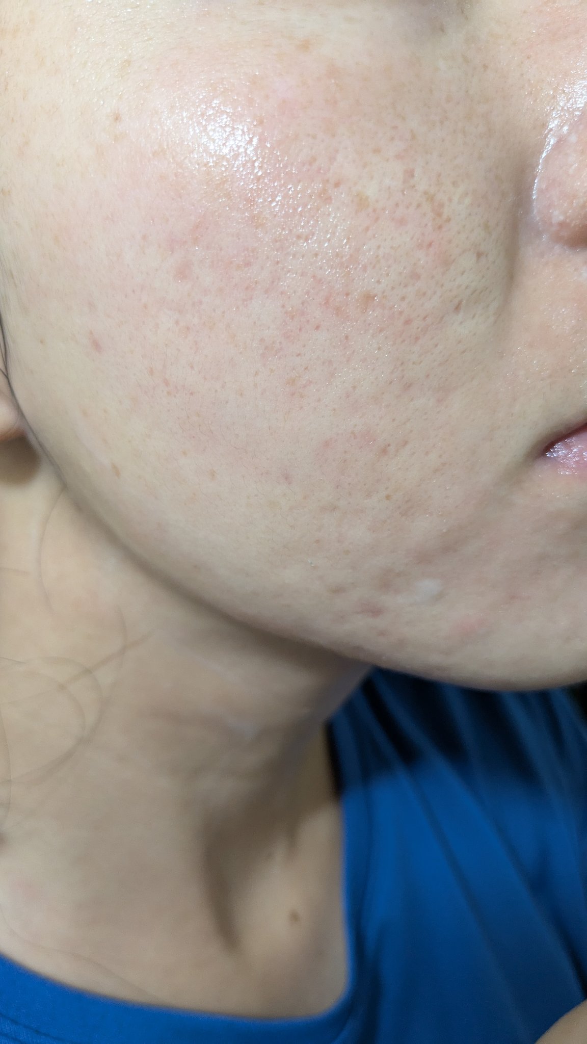 A2+NAG2ソリューション/The Ordinary/美容液を使ったクチコミ（1枚目）