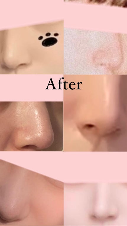 つぐみ on LIPS 「こんにちは!つぐみと申します!今回は私が鼻の形を変えた方法を伝..」(4枚目)