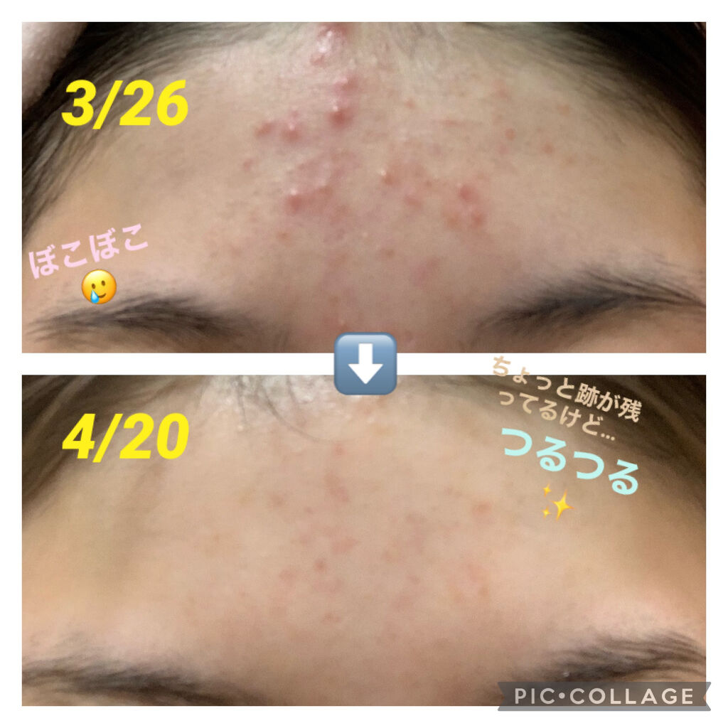 皮脂トラブルケア 保湿ジェル/キュレル/化粧水を使ったクチコミ（2枚目）