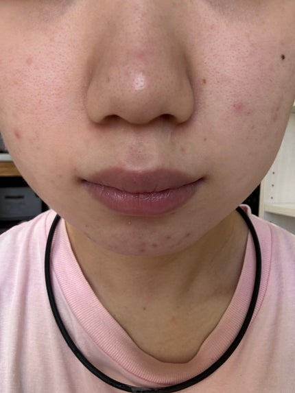 薬用しみ集中対策 プレミアム美容液/メラノCC/美容液を使ったクチコミ(5枚目)