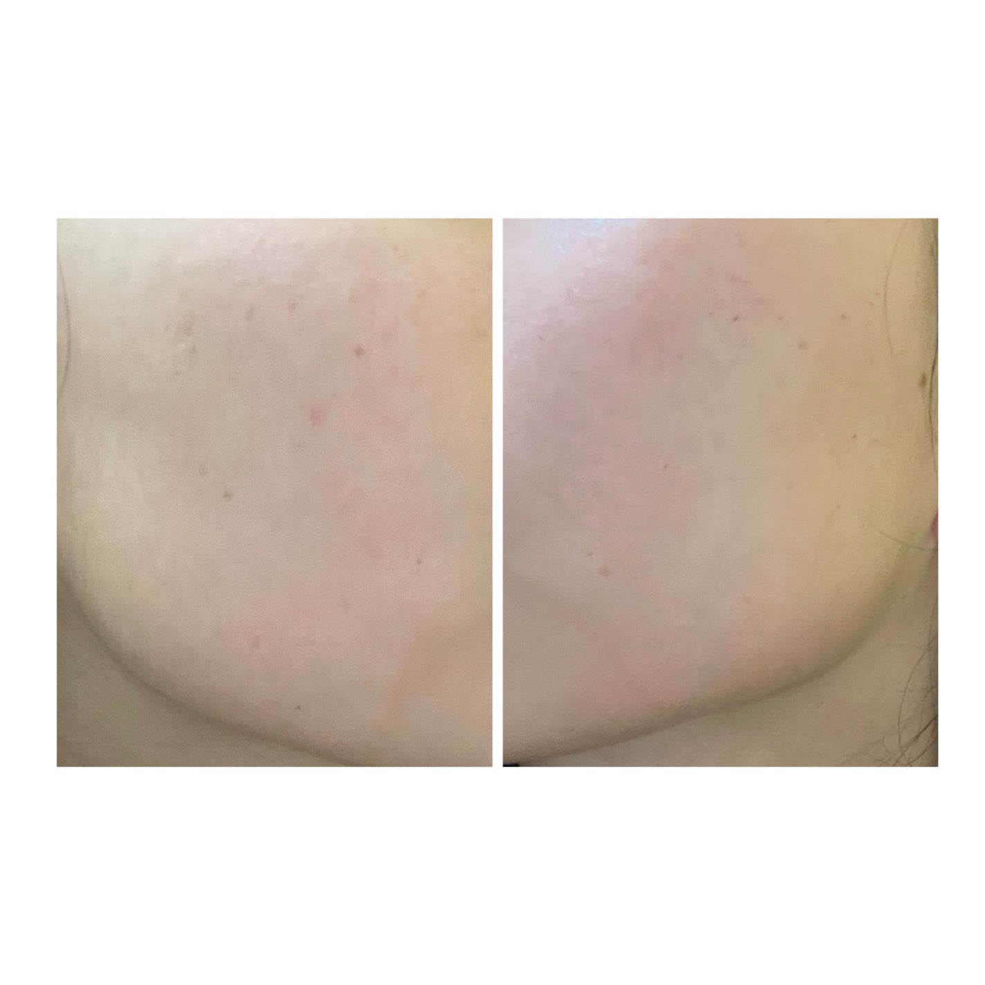 ぽむ on LIPS 「2023.9.13皮膚科に受診 エピデュオとヘパリン処方1枚目..」(5枚目)