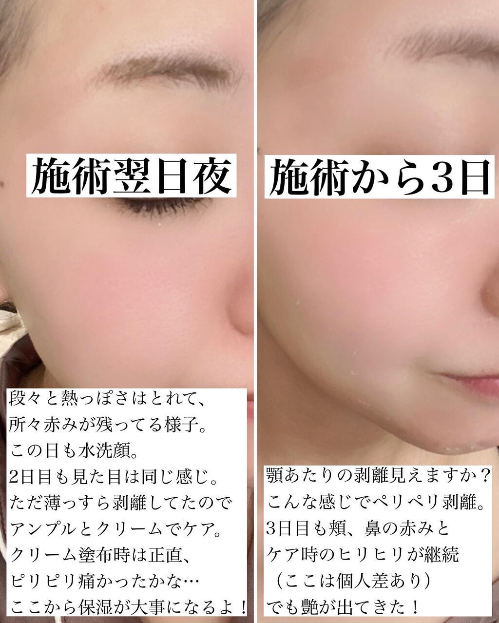 未開封品 ダーマスキンピーリング 2点セット サンクリーム付き 試して