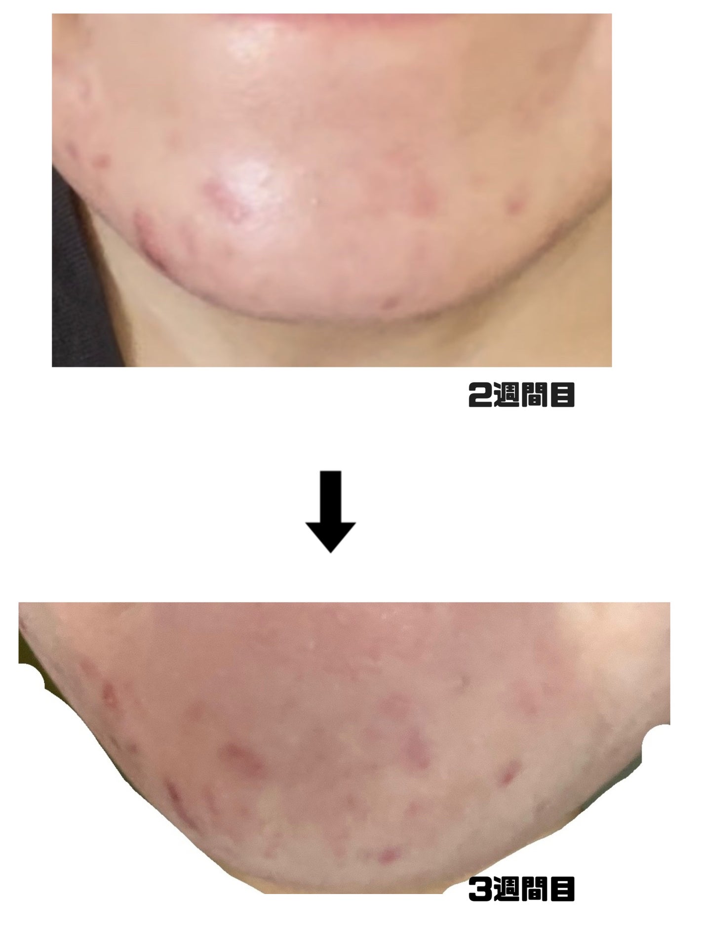 みこ on LIPS 「【ニキビ治療経過記録】閲覧注意です!!エピデュオゲルやその他も..」(4枚目)