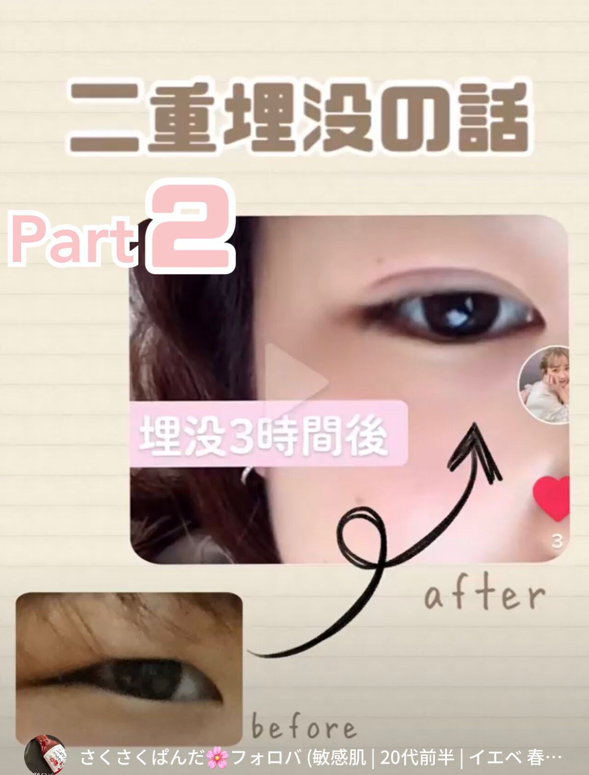 さくさくぱんだ🌸フォロバ on LIPS 「【本当に勇気出して良かった】二重整形お金も時間もかけて勇気を出..」(1枚目)