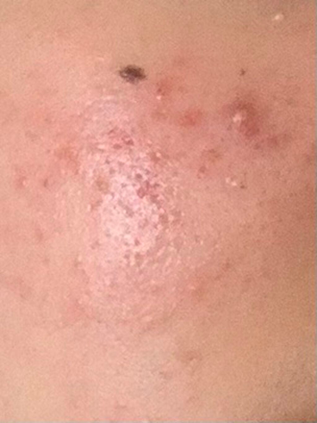 supreme_make_0qyu on LIPS 「助けてくださいニキビ跡が治りません17歳、女子、乾燥肌だけど脂..」(1枚目)