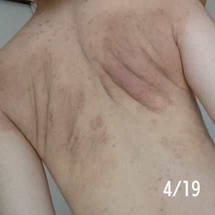 メンタームEXプラスクリーム(医薬品)/メンターム/その他を使ったクチコミ(4枚目)