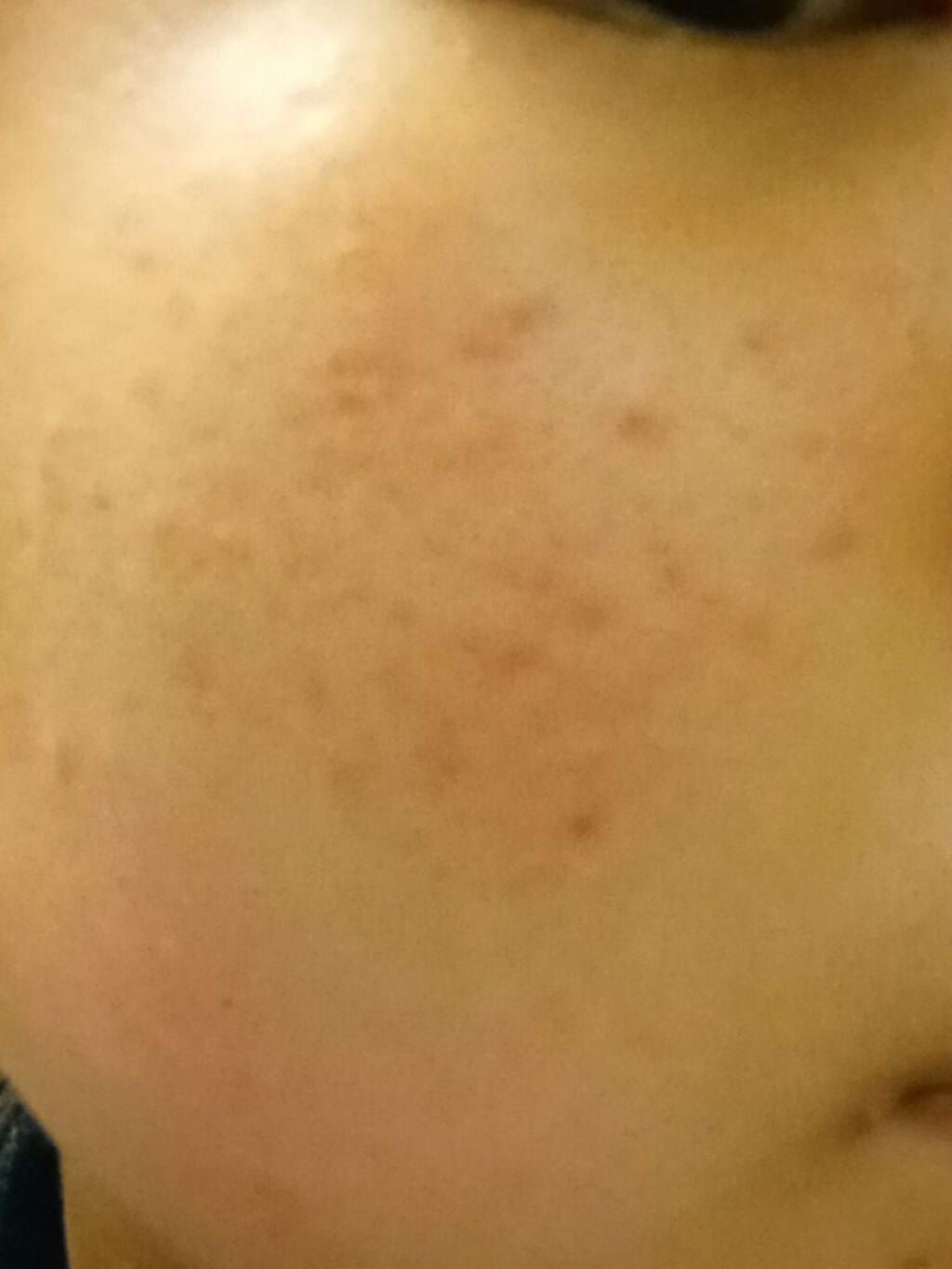 A アクネジェル/NOV/美容液を使ったクチコミ(2枚目)