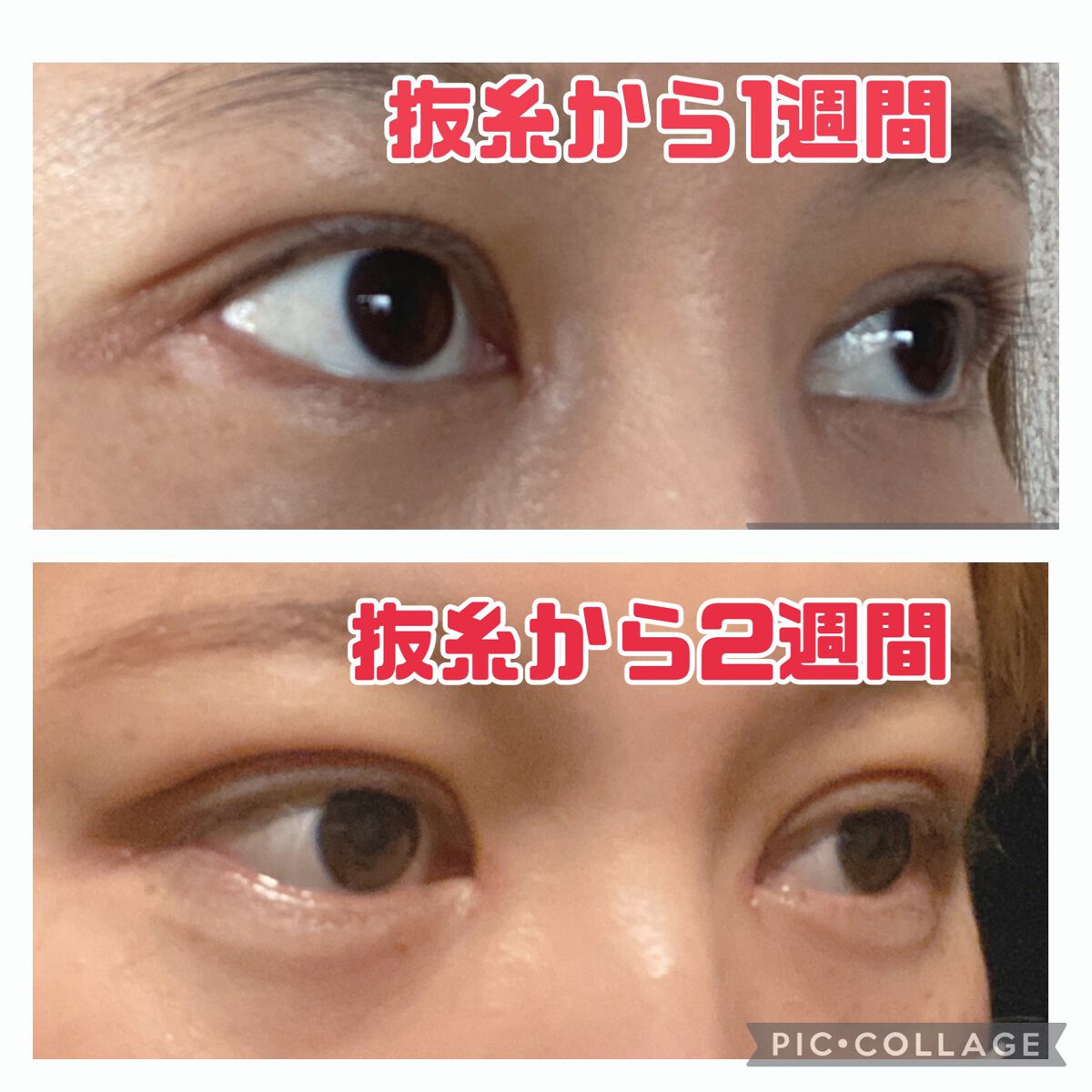 ふうせん @フォロバ100% on LIPS 「3月17日抜糸から2週間今日は、ちょっと腫れてました。その日の..」(3枚目)