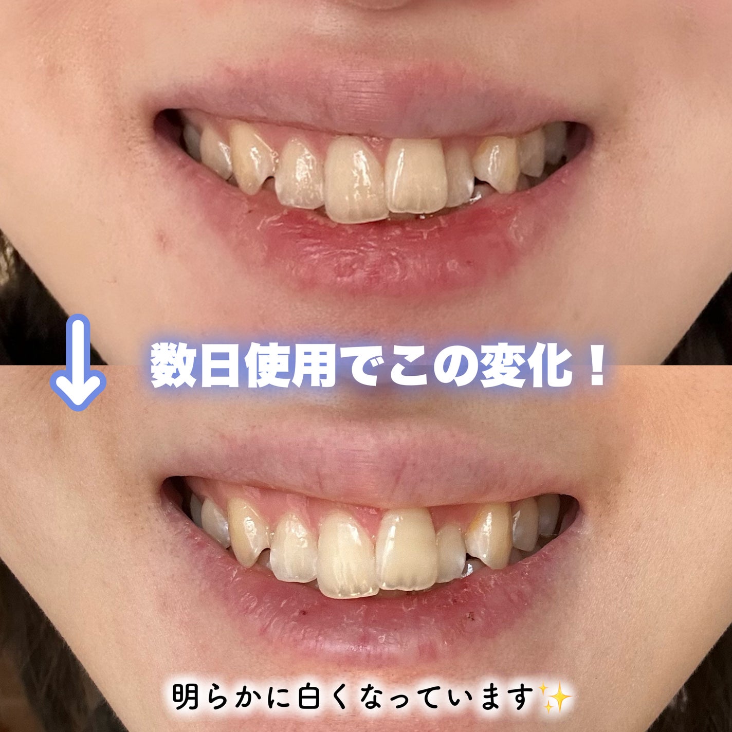 アパガードプレミオ/アパガード/歯磨き粉を使ったクチコミ(4枚目)