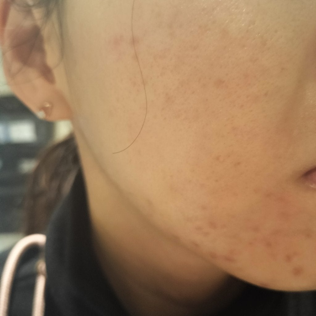 miina@汚肌工事録⚠️ on LIPS 「2023/05/29の#汚肌工事録ピンボケ😂オーストラリア照明..」(1枚目)