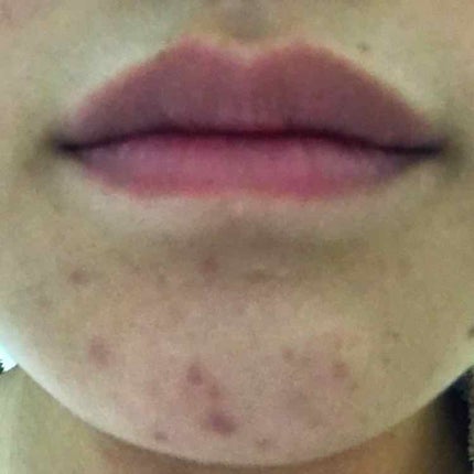 テラ・コートリル 軟膏(医薬品)/ジョンソン・エンド・ジョンソン/その他を使ったクチコミ(3枚目)