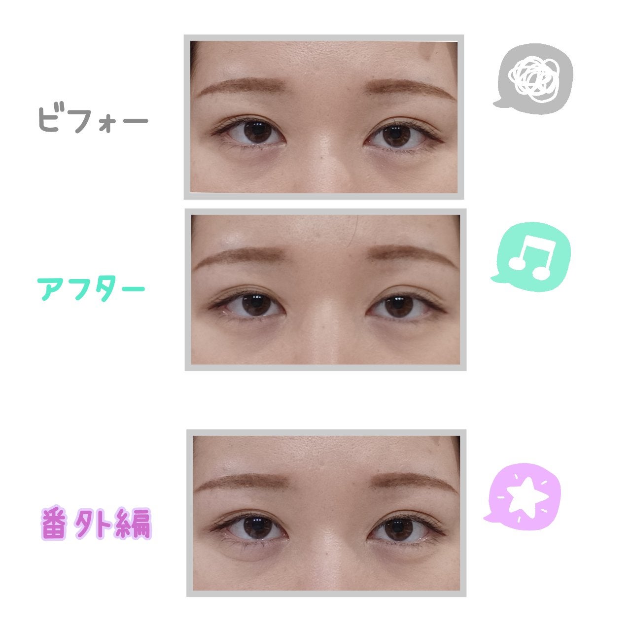 TWOOL ダブルアイリッドグルー/SHOBIDO/二重まぶた用アイテムを使ったクチコミ(3枚目)