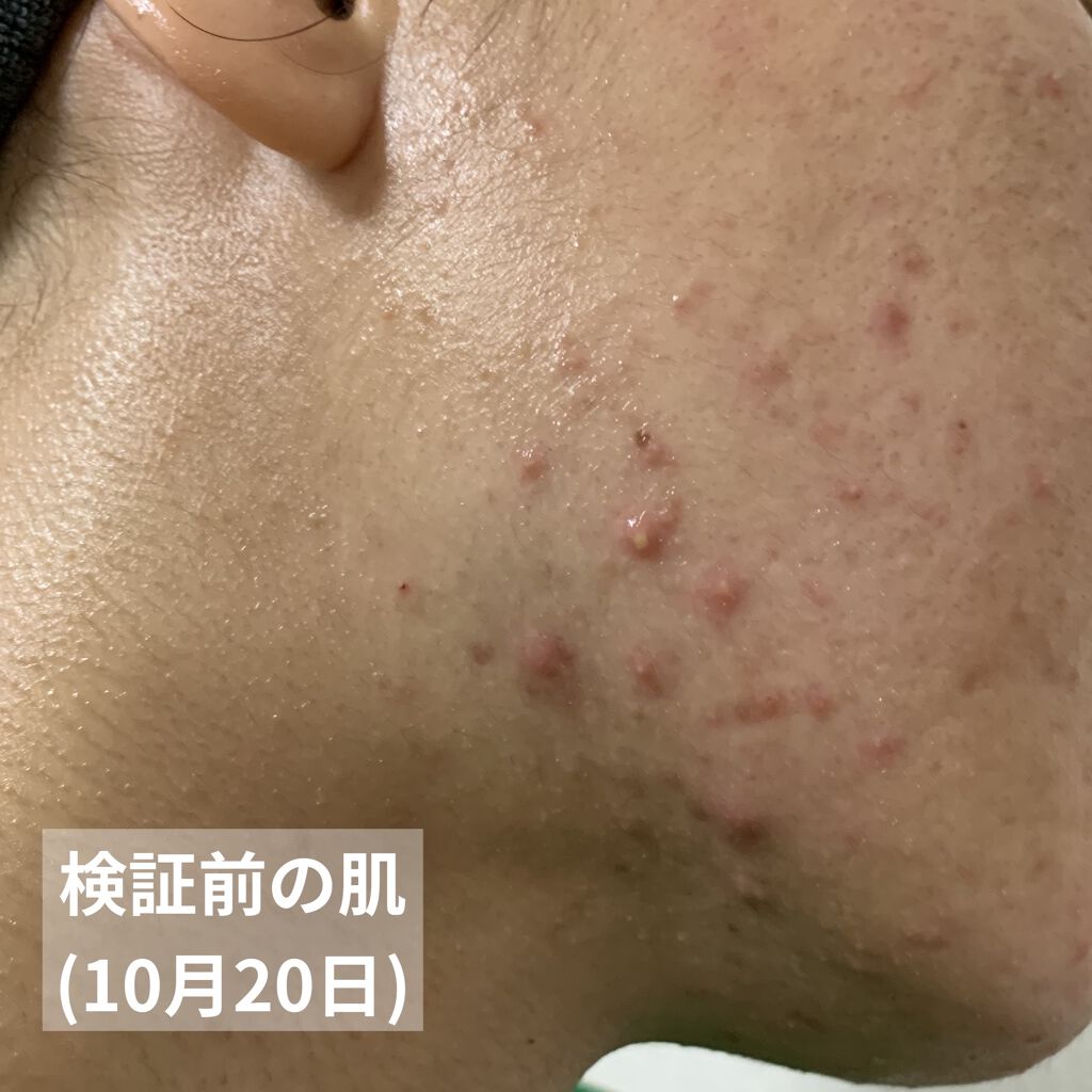 ペアアクネクリームW(医薬品)/ペア/その他を使ったクチコミ（3枚目）