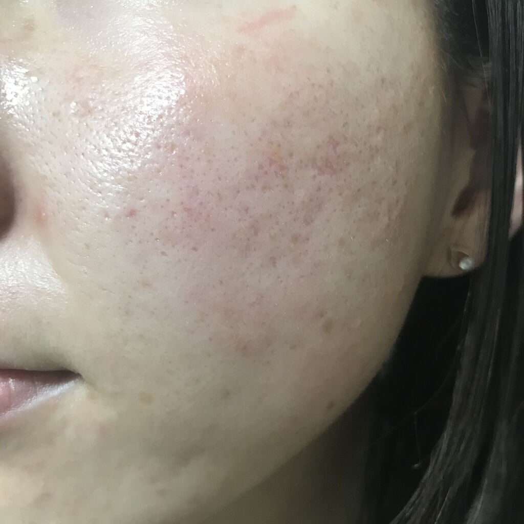 ゼロスポットパッチ/Today’s Cosme/その他スキンケアを使ったクチコミ（2枚目）