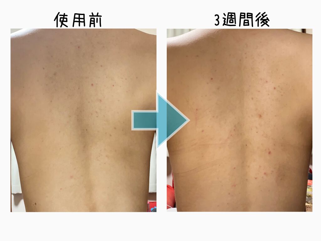 薬用パウダー化粧水/メンソレータム アクネス/化粧水を使ったクチコミ(3枚目)