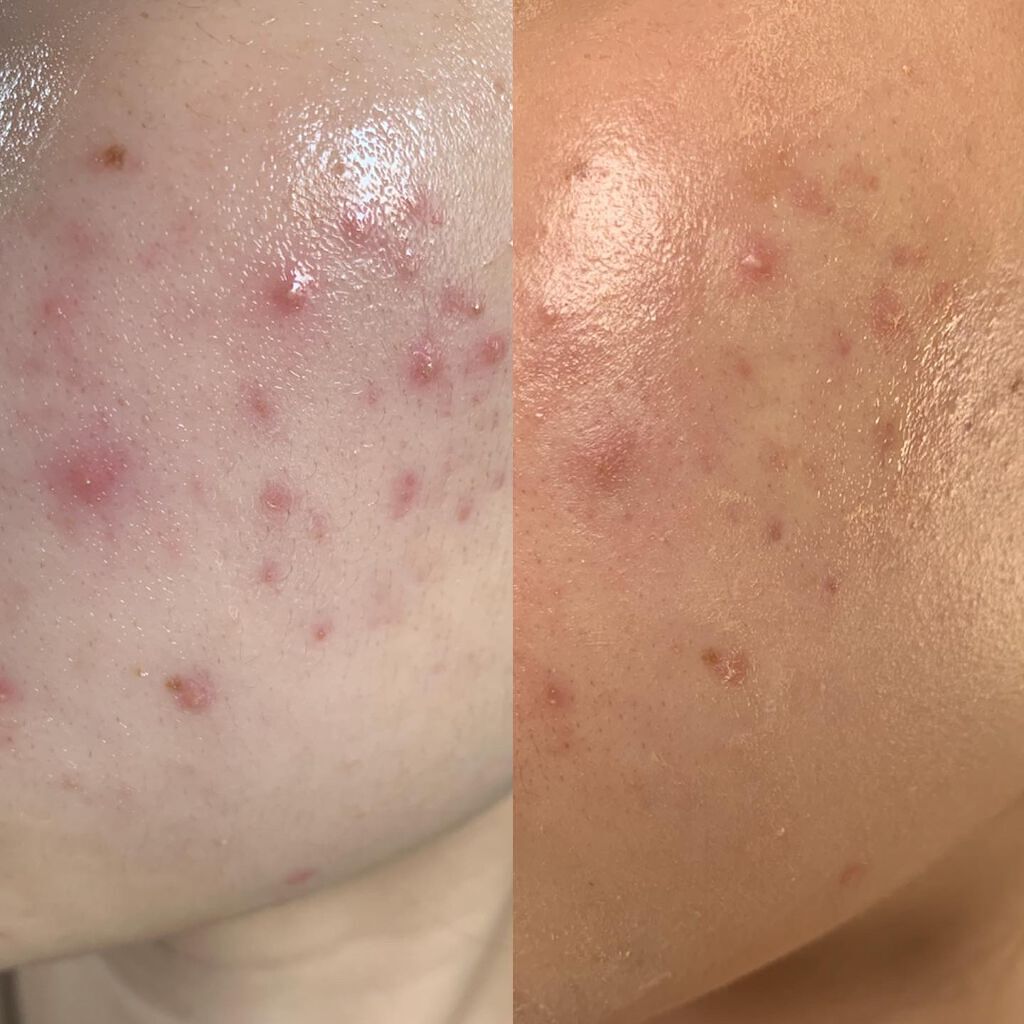 テラ・コートリル 軟膏(医薬品)/ジョンソン・エンド・ジョンソン/その他を使ったクチコミ（2枚目）