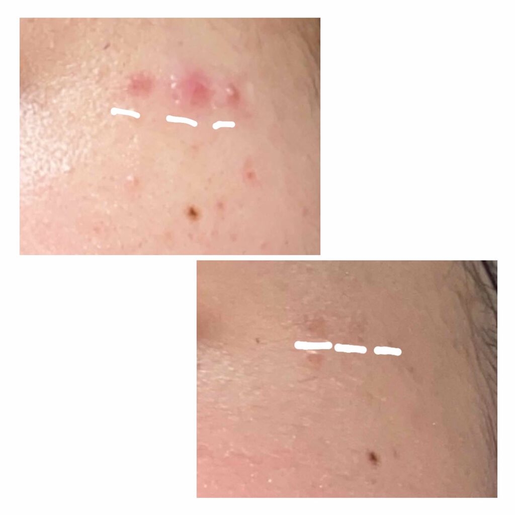 ノブ Ａ アクネソープ/NOV/洗顔石鹸を使ったクチコミ（3枚目）