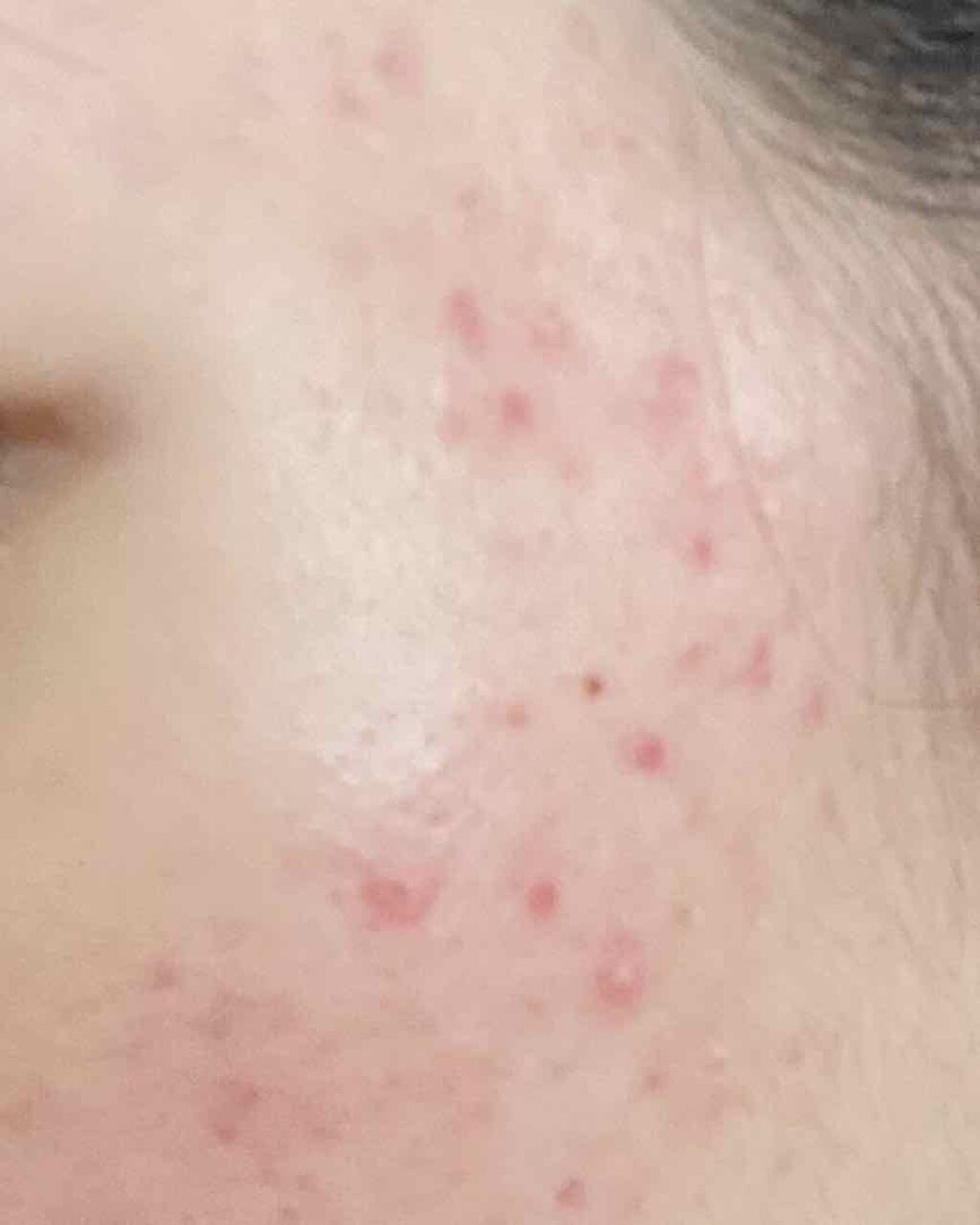 ベピオゲル/マルホ株式会社/その他を使ったクチコミ（1枚目）