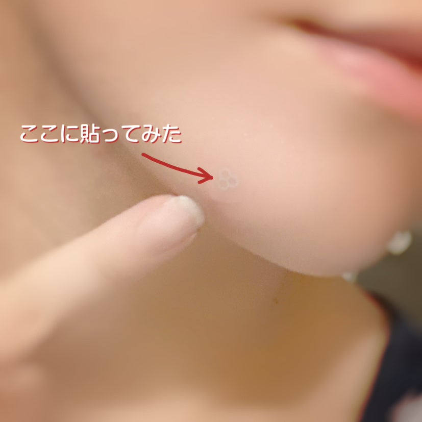 ACマグネシウムパッチ ミニ/スノーツープラス/にきびパッチを使ったクチコミ(5枚目)