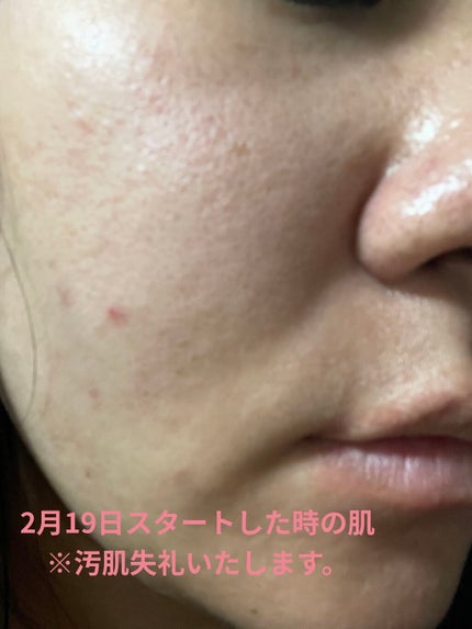 レチノールA 1% アドバンスドリバイタリゼーションクリーム/Life-flo/フェイスクリームを使ったクチコミ(2枚目)