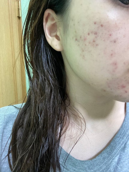 オードムーゲ 薬用ローション(ふきとり化粧水)/オードムーゲ/拭き取り化粧水を使ったクチコミ(2枚目)