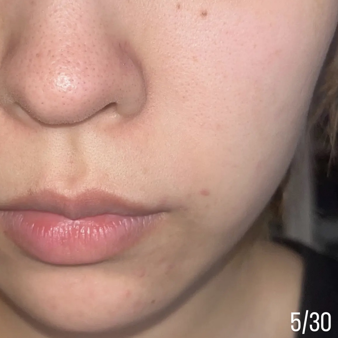 ペアアクネクリームW(医薬品)/ペア/その他を使ったクチコミ（3枚目）