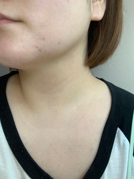 ハトムギ化粧水(ナチュリエ スキンコンディショナー R )/ナチュリエ/化粧水を使ったクチコミ(5枚目)