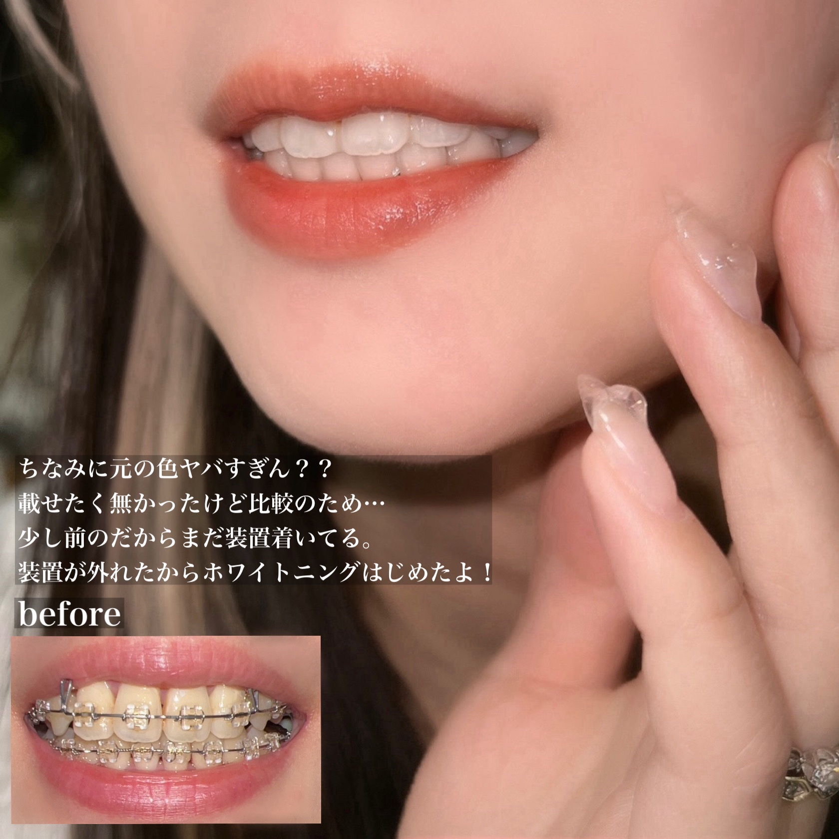 クレスト3Dホワイトニング ホワイトストリップ プロフェッショナル エフェクツ/クレスト/その他オーラルケアを使ったクチコミ（2枚目）