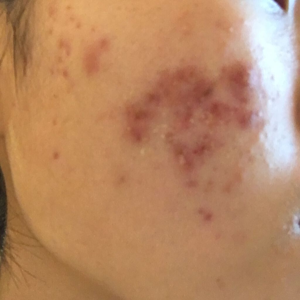 オロナインH軟膏 (医薬品)/オロナイン/その他を使ったクチコミ(2枚目)