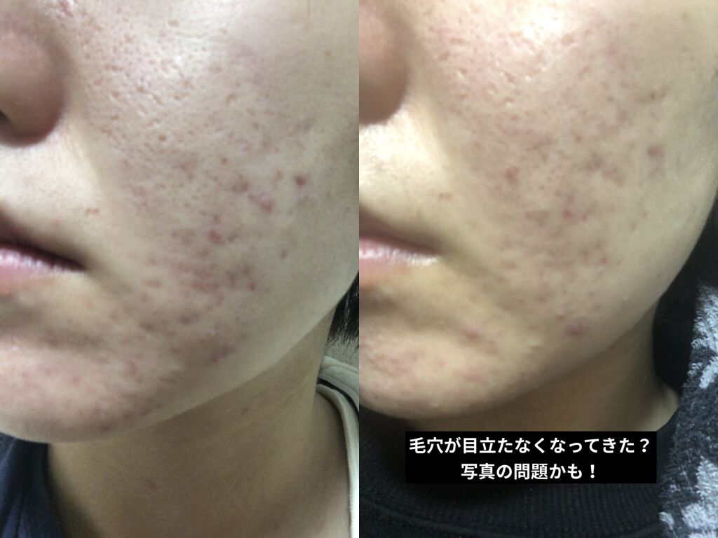 ドクタージャルト シカペア リカバー (第2世代）/Dr.Jart＋/フェイスクリームを使ったクチコミ（3枚目）