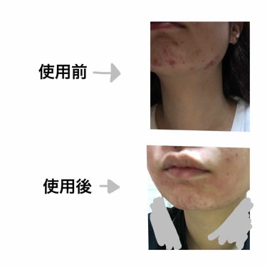 さはら on LIPS 「ここ数ヶ月大量のニキビが発生して憂鬱な日々を過ごしていますニキ..」（3枚目）