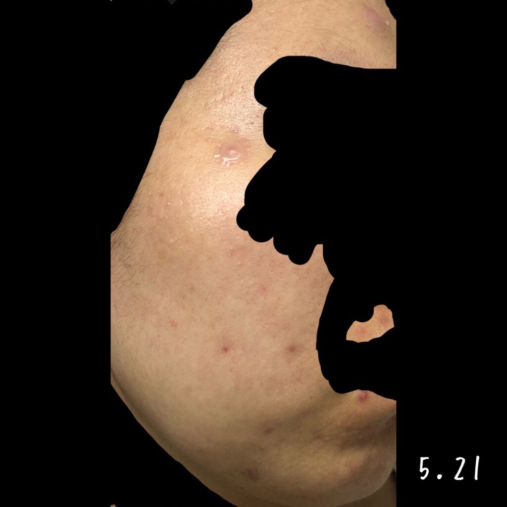 ベジータ on LIPS 「下書き消化! 5.21〜5.30オルビスのニキビケアシリーズ気..」(3枚目)