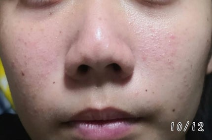 薬用 しみ 集中対策 美容液/メラノCC/美容液を使ったクチコミ(4枚目)