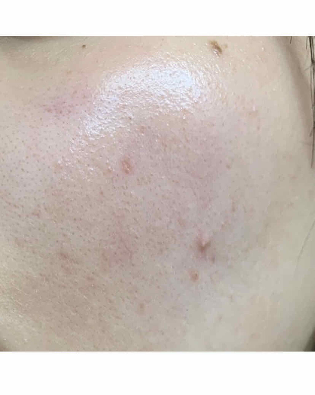 薬用3ステップセット30日サイズ/プロアクティブ/トライアルキットを使ったクチコミ（3枚目）