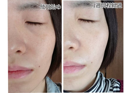 タカミスキンピール/タカミ/ブースター・導入液を使ったクチコミ(6枚目)