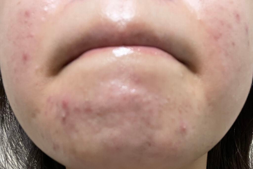 まままこ on LIPS 「ニキビゼロ肌を目指して〜8日目〜⚠️2枚目から肌画像ありスキン..」(4枚目)