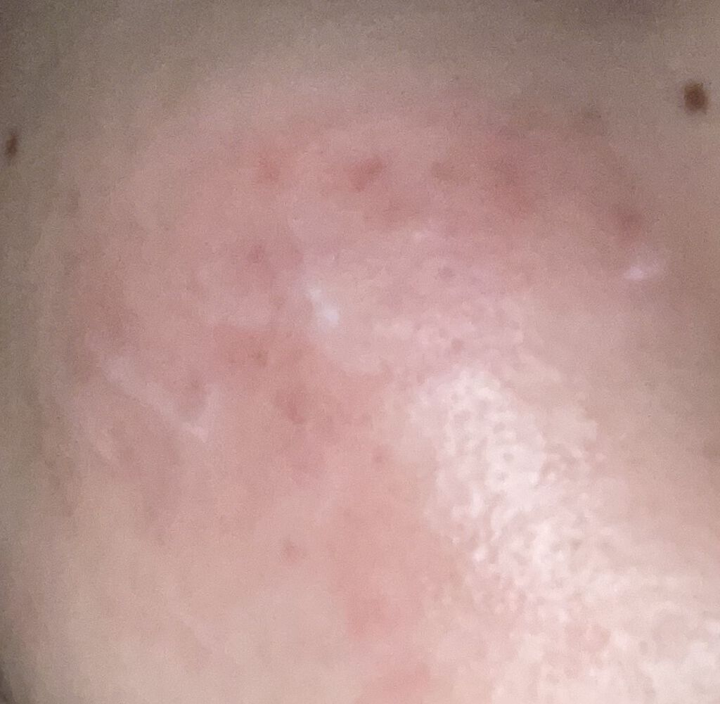 ディフェリンゲル0.1%/ガルデルマ/その他スキンケアを使ったクチコミ（2枚目）